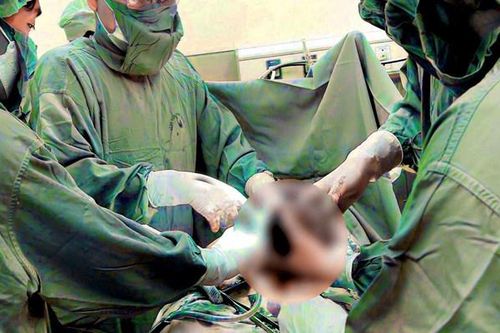 Sản phụ vào phòng đẻ nói chuyện bình thường bỗng tím tái khó thở do tai biến cực kỳ nguy hiểm