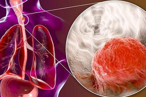 Chế độ ăn cho bệnh nhân ung thư thực quản