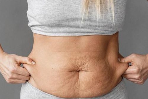 Hút mỡ sau sinh: Nên kiệt hay không kiệt?