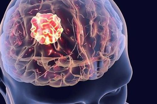 6 dấu hiệu cảnh báo u não