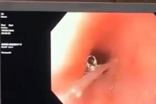 Cháu bé 4 tuổi nuốt cúc áo