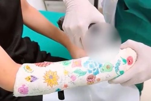 Vẽ lên bột trong lúc đang gãy tay, bé gái khiến bác sĩ không muốn tháo thành quả quá đẹp
