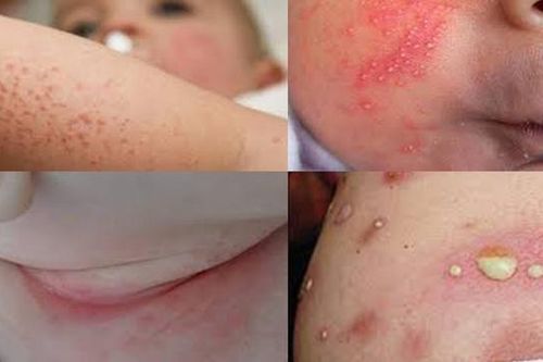 Thời tiết oi nóng dễ bị viêm da mủ, chữa thế nào?