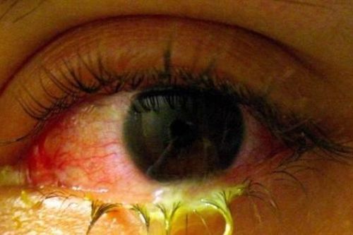 5 bệnh có thể gặp phải khi bỗng nhiên nhiều gỉ mắt