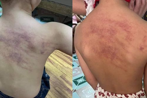 Hải Phòng: Cảnh cáo 3 giáo viên để xảy ra việc cháu bé 5 tuổi bị bầm tím vùng lưng