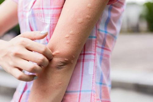 Lý do bạn bị muỗi đốt nhiều hơn người khác
