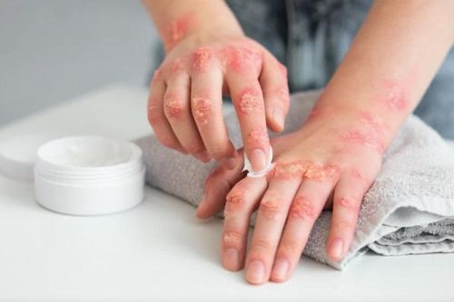 Bệnh vảy nến có điều trị dứt điểm được không?