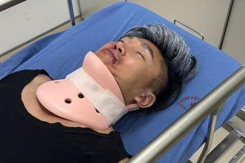 Ca sĩ Du Thiên bị thương nặng, mặt bầm tím phải cấp cứu giờ ra sao?