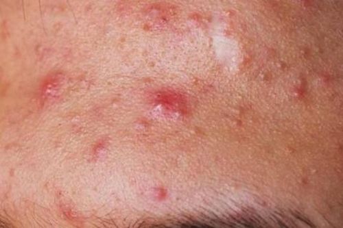 Xử trí và phòng ngừa dị ứng mỹ phẩm