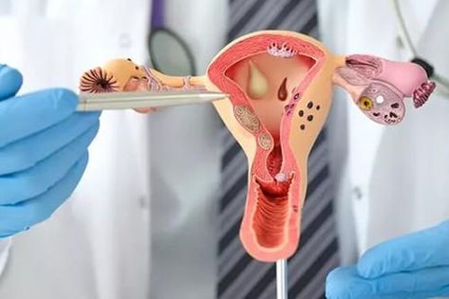 Buồng trứng đa nang ảnh hưởng tới khả năng sinh sản như thế nào?