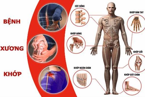 Thách thức của bệnh xương khớp: Lối sống và nhận thức