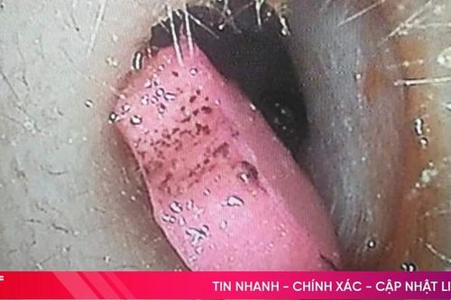 Bác sĩ gắp cục tẩy để lâu ngày trong tai của bé 5 tuổi
