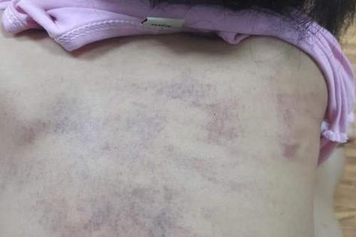 Hải Phòng thông tin việc trẻ mẫu giáo 5 tuổi bầm tím lưng