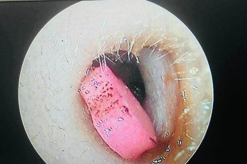 Bé 6 tuổi sốt nhập viện, bác sĩ phát hiện cục tẩy trong tai