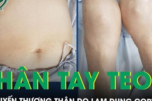 2 mẹ con mặt tròn, chân tay teo, suy tuyến thượng thận do lạm dụng thuốc corticoid