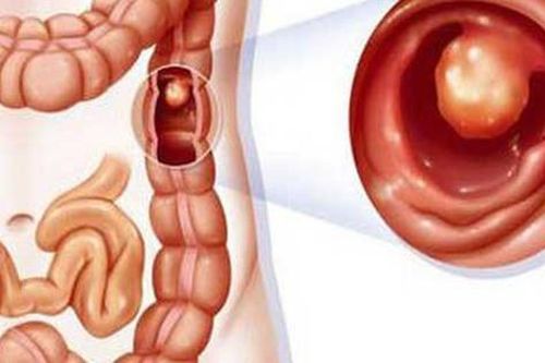 Điều trị ung thư đại tràng như thế nào?
