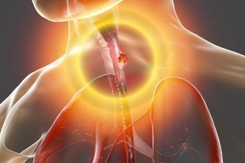 6 câu hỏi thường gặp về ung thư thực quản