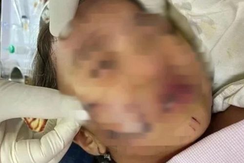 Đang chơi, bé gái 11 tuổi ở Phú Thọ bất ngờ bị chó hàng xóm cắn trọng thương vùng đầu, gáy