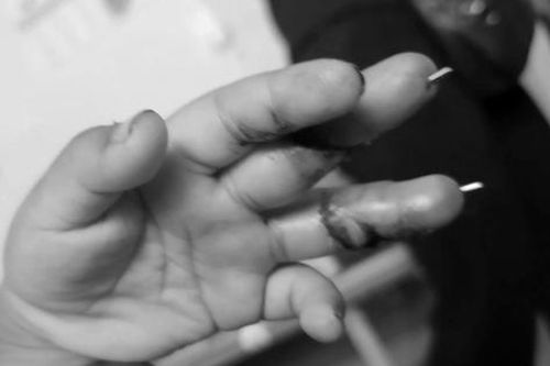 Quạt chém đứt 2 ngón tay bé trai khi sang hàng xóm chơi