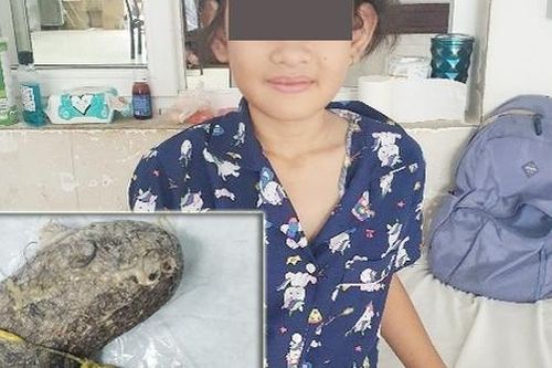 Bệnh nhi 11 tuổi mắc hội chứng nghiện ăn tóc