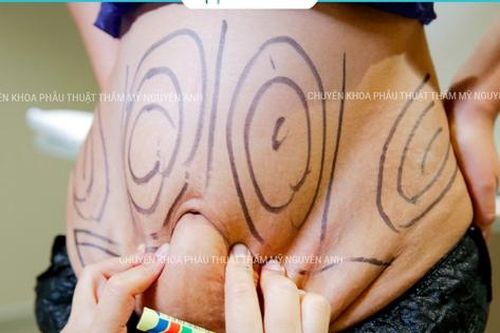 Nhồi máu não diện rộng sau hút mỡ tại Viện thẩm mỹ Nguyên Anh