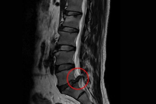 Sợ mổ thoát vị đĩa đệm phải nằm liệt cả tuần, không ngờ sau 2 ngày đi lại dễ dàng