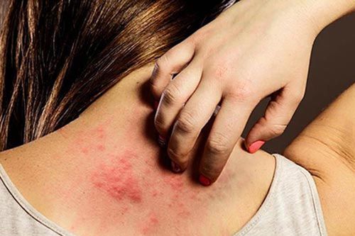 Khổ sở vì cứ đến hè lại bị nổi mẩn, ngứa khắp người