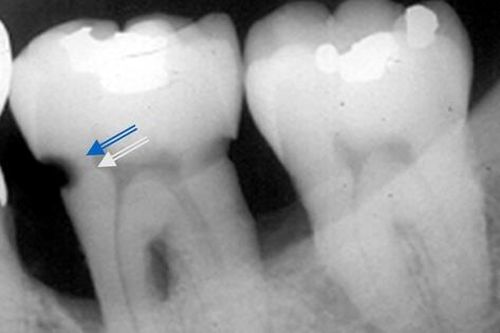 Các phương pháp điều trị sâu răng