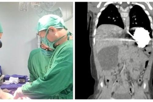 Bé 11 tháng tuổi mắc chứng tắc tá tràng bẩm sinh hiếm gặp