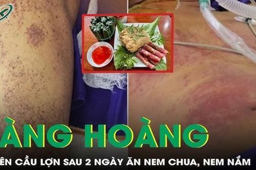 Bị liên cầu lợn sau 2 ngày ăn nem chua ở quán bia