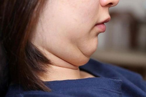 5 mẹo đơn giản giúp bạn giảm mỡ mặt mà không cần động dao kéo