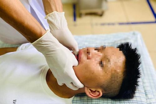 Hy hữu: Nam thanh niên bị trật khớp hàm sau khi ngáp lớn