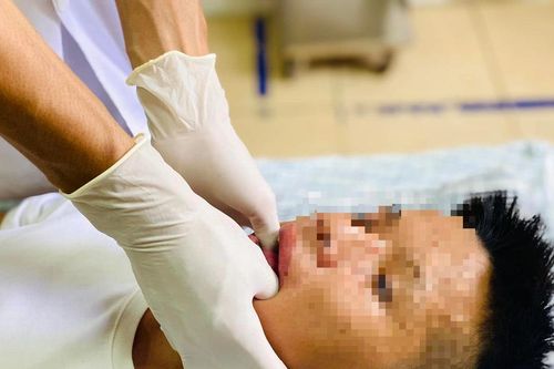 Trật khớp hàm sau khi ngáp lớn