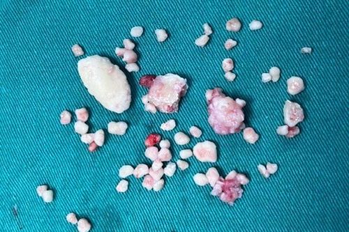 Gắp 50 viên 'sỏi' khỏi khớp khuỷu tay cho người mắc bệnh hiếm