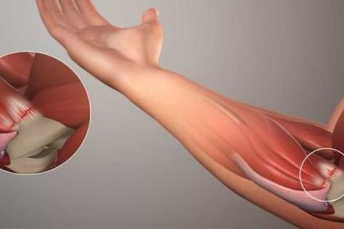 Thấy lạo xạo và đau nhức, người đàn ông đi khám bất ngờ phát hiện 50 viên sỏi trong khuỷu tay