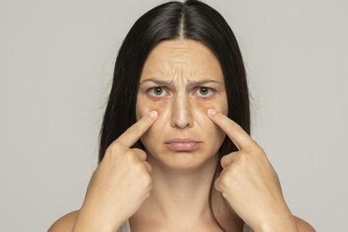 5 mẹo giảm thâm mắt hiệu quả nhanh