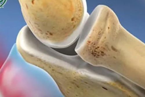 Loại bỏ 50 viên sụn khỏi khớp khuỷu tay của bệnh nhân mắc căn bệnh hiếm