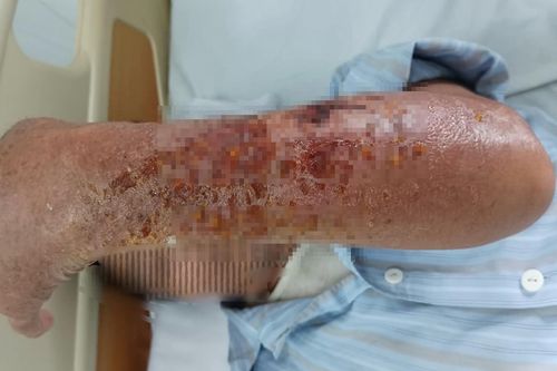 Cánh tay chảy dịch, nhiễm trùng sau khi bị mèo cào