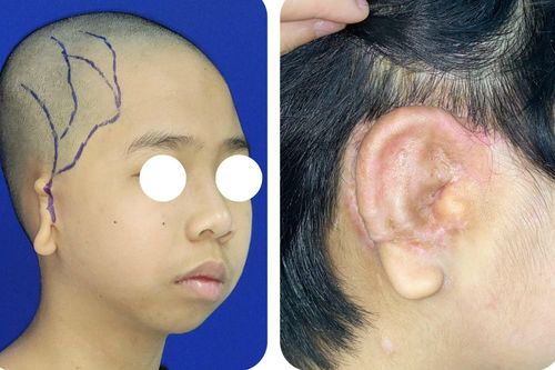 Bé 5 tuổi lép nửa mặt, dị tật tai nhỏ được phẫu thuật thành công