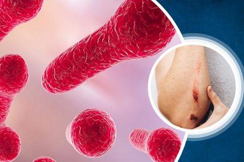 Điều trị uốn ván như thế nào?