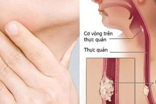 Người đàn ông phát hiện ung thư thực quản thừa nhận 1 sai lầm mà nhiều người Việt đang mắc phải
