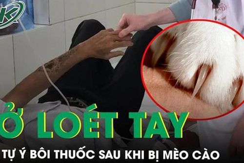 Lở loét ở cánh tay do tự ý bôi thuốc sau khi mèo cào: Bác sĩ cảnh báo nguy cơ