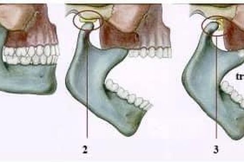 Nam bệnh nhân trật khớp hàm vì ngáp lớn phải nhập viện