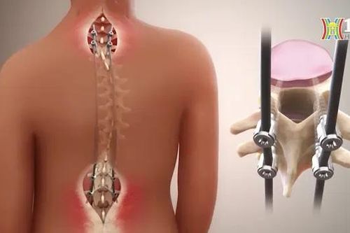 Chữa gù vẹo cột sống chỉ một lần với nẹp tăng trưởng