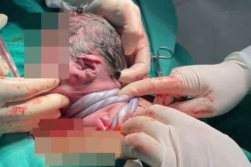 Em bé ở Hà Nội chào đời với dây rốn quấn 3 vòng cổ