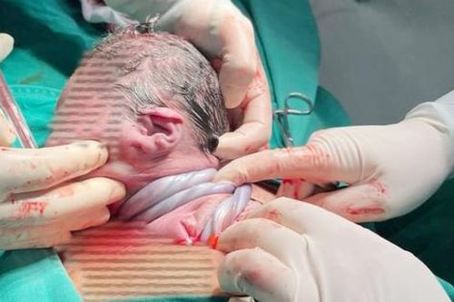 Cứu sống thai nhi có dây rau quấn cổ 3 vòng, suy thai