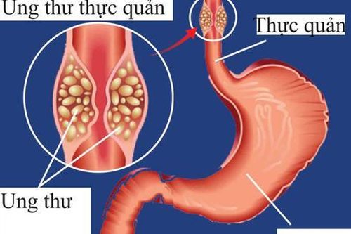 Các loại thuốc điều trị ung thư thực quản