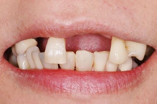 Rụng răng ở người già có phòng ngừa được không?