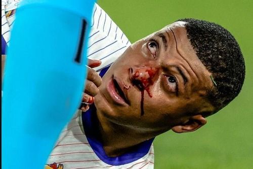 Mbappe bị gãy mũi