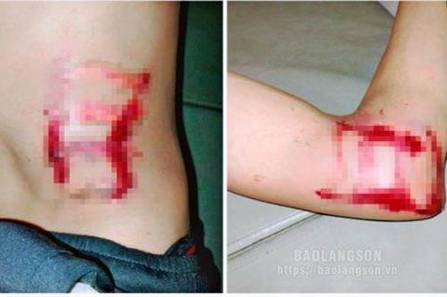 Thanh niên 29 tuổi ở Lạng Sơn bị sét đánh ngất ngay trong phòng ngủ, lúc nửa đêm